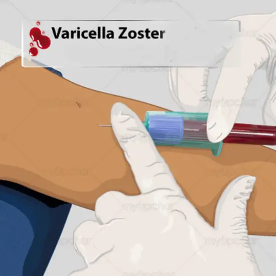 Varicella-Zoster Virus Antibody (IgG) Test